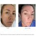 Replenix Glycolic Acid 10% Resurfacing Peel 60 pads